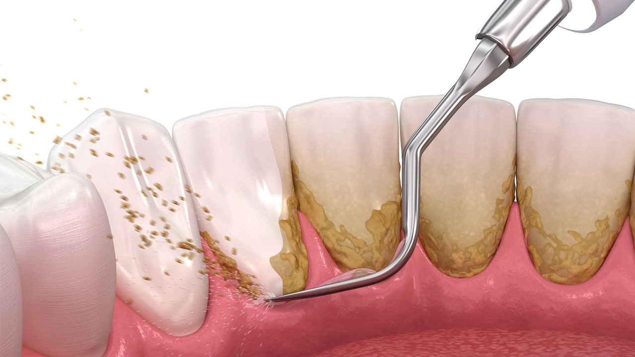 Cập nhật phí lấy cao răng hiện nay