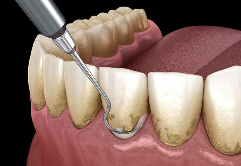 Cập nhật phí lấy cao răng hiện nay