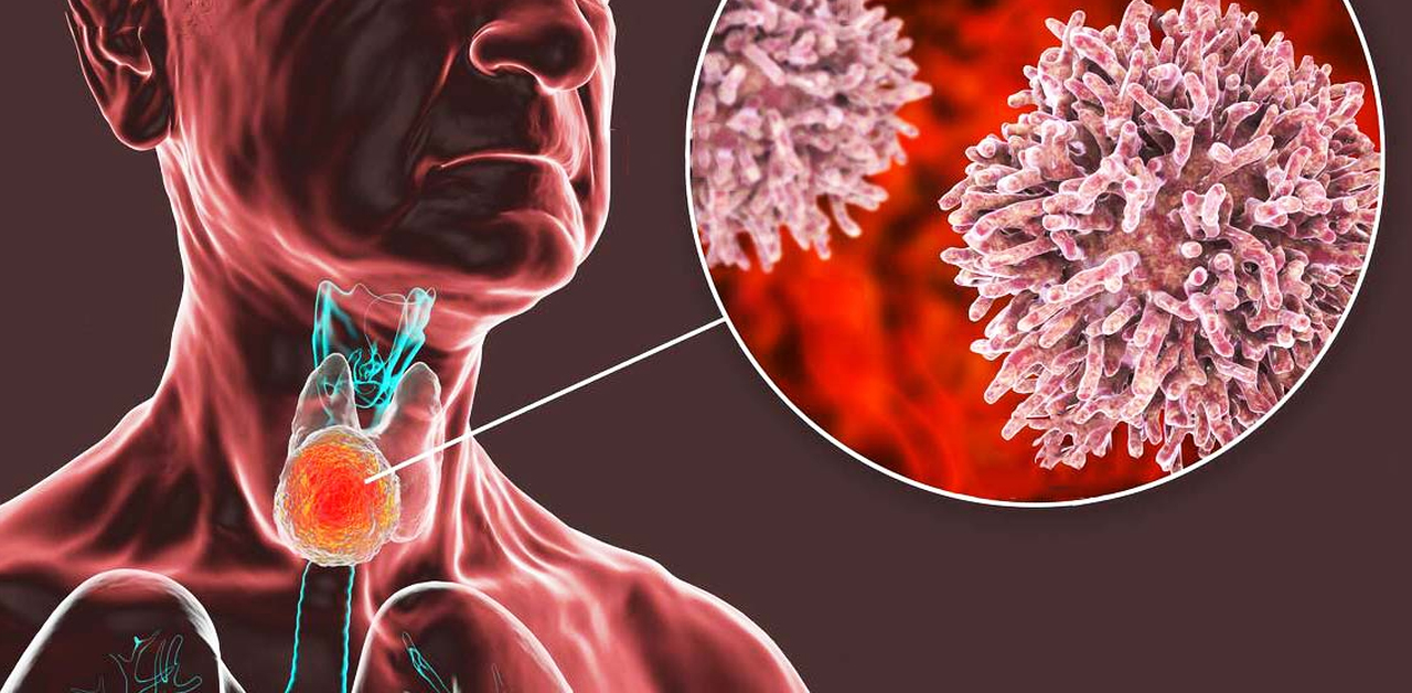 Carcinoma tuyến giáp thể nhú có chữa được không?