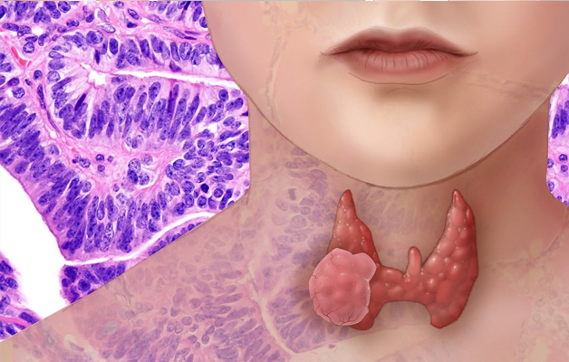 Carcinoma tuyến giáp thể nhú có chữa được không?