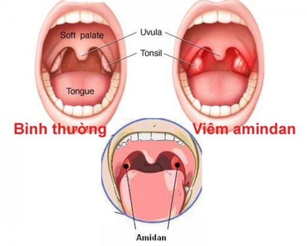 Cắt amidan bao nhiêu tiền? hiệu quả ngay lần điều trị