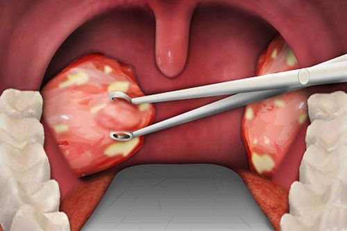 Cắt amidan cho trẻ em an toàn, không đau: Khi nào và ở đâu?