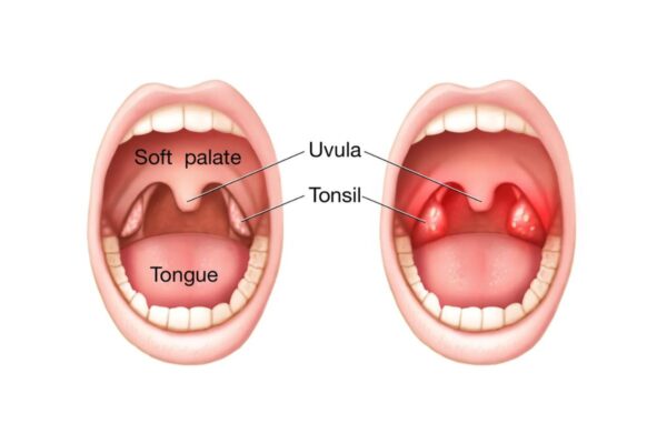 Cắt amidan giá bao nhiêu, khi nào cần cắt?