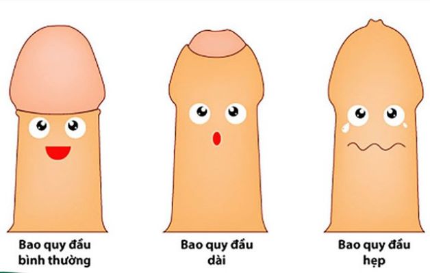 Cắt bao quy đầu để làm gì? Vì sao phải cắt bao quy đầu?