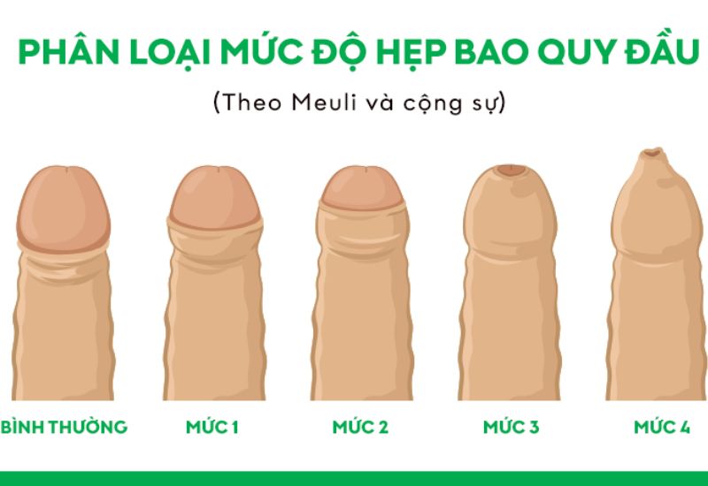 Cắt bao quy đầu: lợi ích, quy trình và một số lưu ý