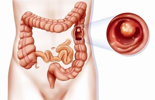 Cắt bỏ polyp đại tràng ở đâu?