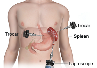 Cắt lá lách có ảnh hưởng đến sức khỏe không?