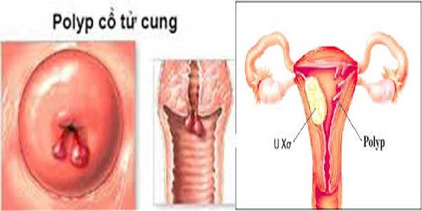 Cắt polyp cổ tử cung ở đâu? tốt nhất ở hà nội