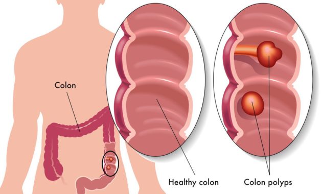 Cắt polyp đại tràng như thế nào? Khi nào cần thực hiện?