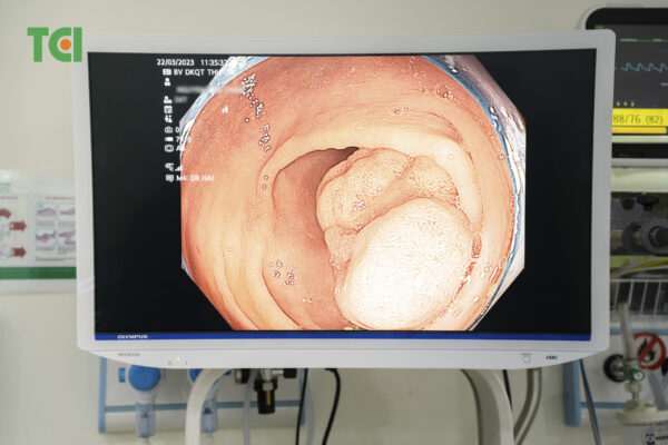 Cắt polyp đại tràng qua nội soi – Phương pháp điều trị tối ưu