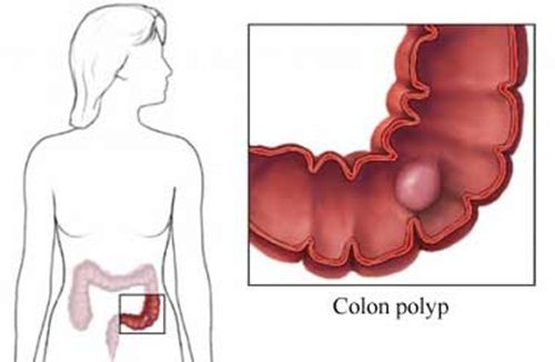 Cắt polyp đại tràng qua nội soi