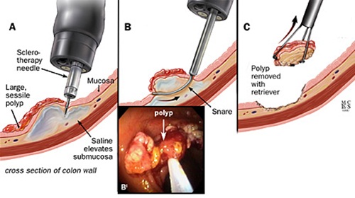 Cắt polyp đại tràng qua nội soi