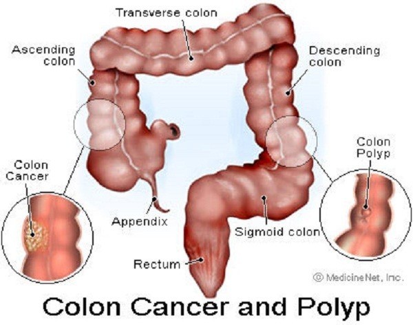 Cắt polyp trực tràng ở đâu?Tại Bệnh viện Thu Cúc