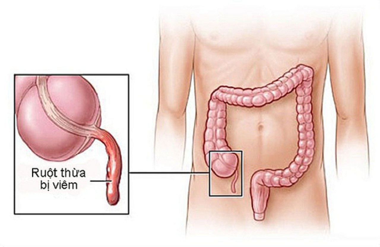 Cắt ruột thừa: chỉ định, quy trình và cách chăm sóc sau mổ