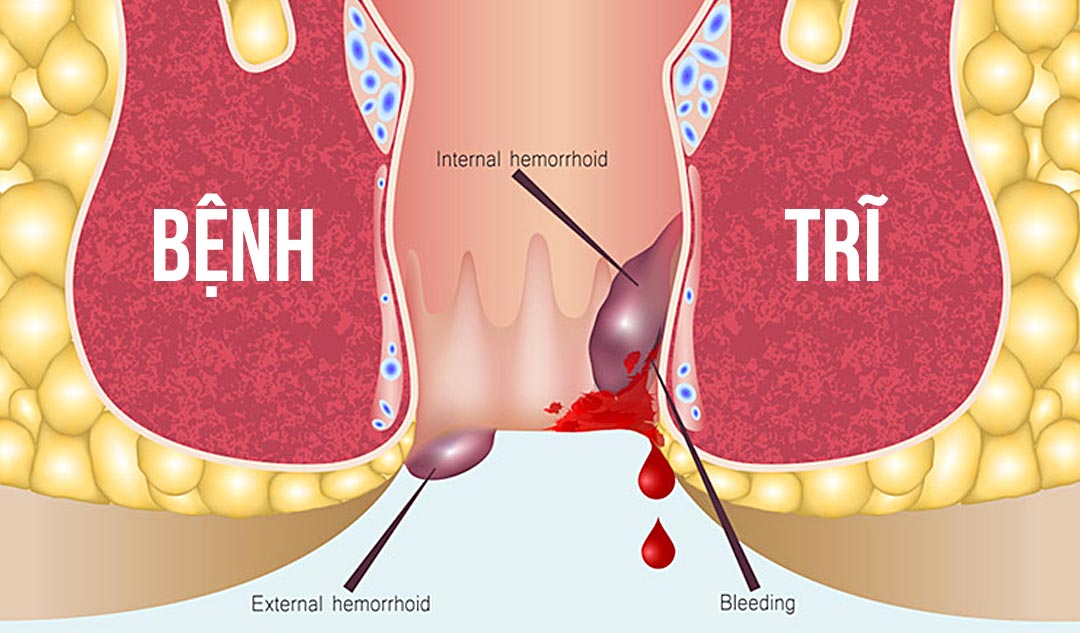 Cắt trĩ bằng phương pháp Longo – thông tin cần biết