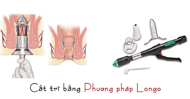 Cắt trĩ bao lâu thì đi làm được? Làm thế nào để vết mổ nhanh lành?