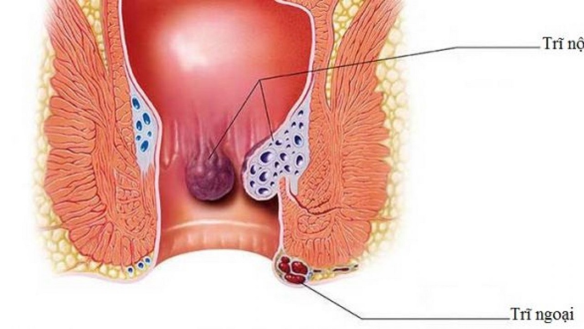 Cắt trĩ hết bao nhiêu tiền, các phương pháp thực hiện