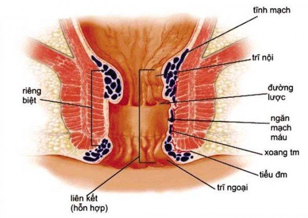 Cắt trĩ hết bao nhiêu tiền, các phương pháp thực hiện