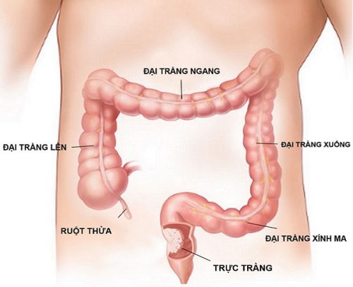 Cắt trực tràng bằng nội soi