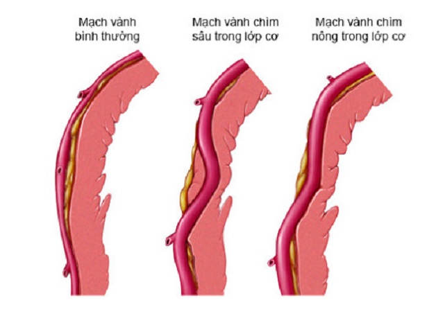 Cầu cơ động mạch vành: Dị tật tim bẩm sinh hiếm gặp