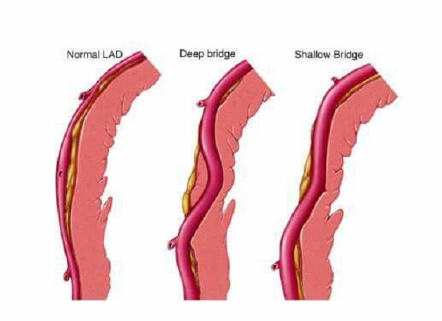 Cầu cơ mạch vành là bệnh gì? Có nguy hiểm không?