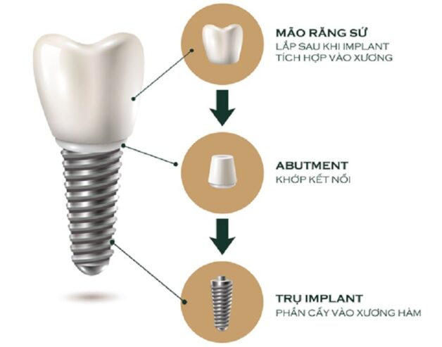 Câu hỏi số 1 trước khi làm răng sứ: 1 cái răng sứ bao nhiêu tiền