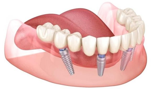 Cấy ghép Implant – giải pháp vàng cho người mất răng