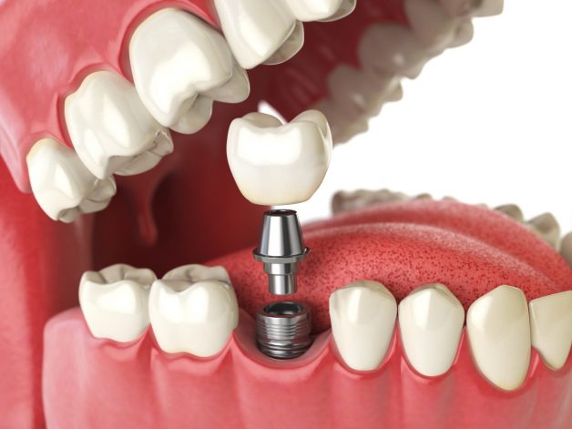 Cấy ghép implant là gì? Cấy ghép implant mất thời gian bao lâu?