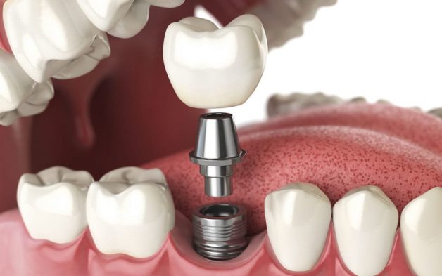 Cấy ghép implant mất thời gian bao lâu thì hoàn thiện?