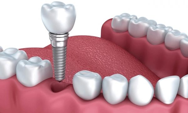 Cấy ghép răng implant có đau không, bạn có biết?