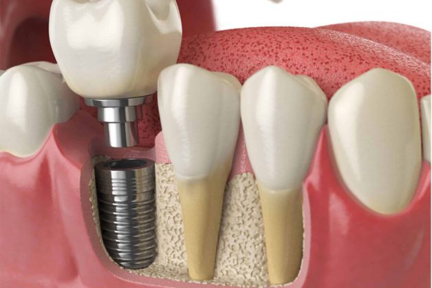 Cấy ghép răng implant có đau không?