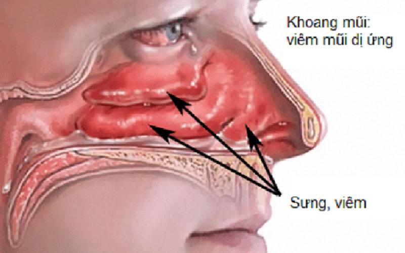 Cetirizin 10mg – Thuốc kháng histamin điều trị dị ứng