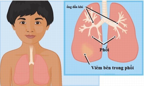 Cha mẹ cần biết: Những dấu hiệu viêm phổi ở trẻ nhỏ