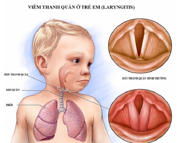 Cha mẹ làm gì với viêm thanh quản ở trẻ nhỏ