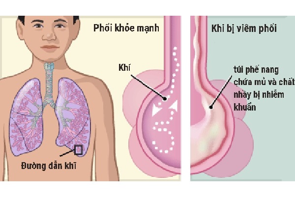 Cha mẹ nên cảnh giác với bệnh viêm phổi ở trẻ em