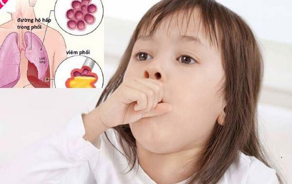 Cha mẹ nên cảnh giác với bệnh viêm phổi ở trẻ em