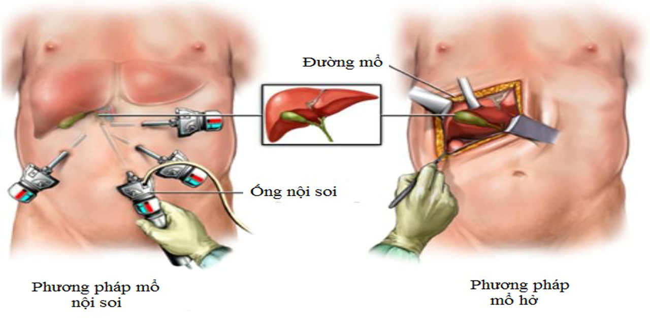 Chăm sóc bệnh nhân sau mổ sỏi mật cần lưu ý gì?