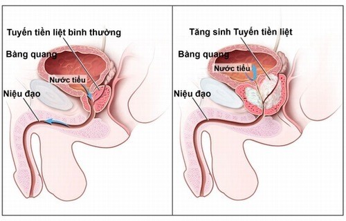 Chăm sóc bệnh nhân sau phẫu thuật u xơ tuyến tiền liệt