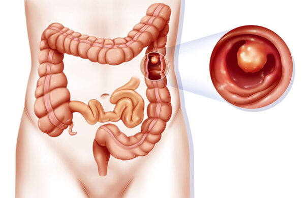 Chăm sóc người bệnh sau phẫu thuật polyp trực tràng