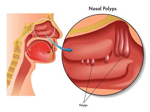 Chăm sóc sau cắt polyp mũi thế nào cho đúng cách