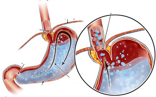 Chẩn đoán bệnh gerd