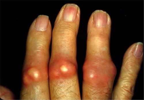 Chẩn đoán bệnh gout ở bệnh viện Thu Cúc