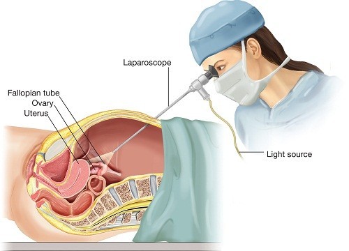 Chẩn đoán chửa ngoài tử cung chính xác và điều trị kịp thời