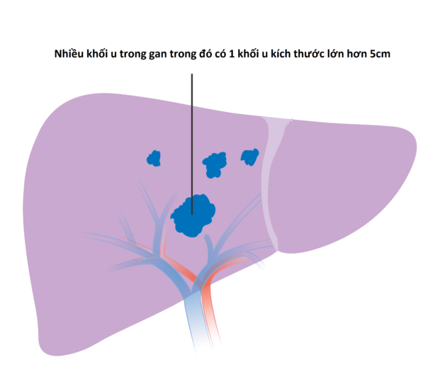 Chẩn đoán, điều trị ung thư gan nguyên phát