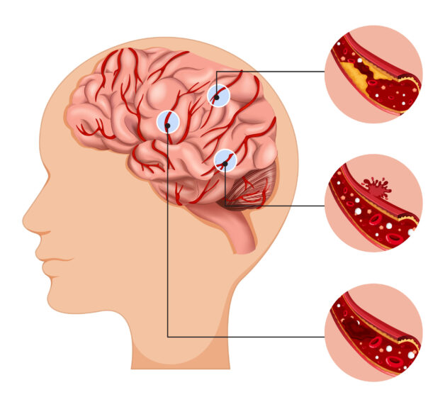 Chẩn đoán hình ảnh và xét nghiệm đột quỵ