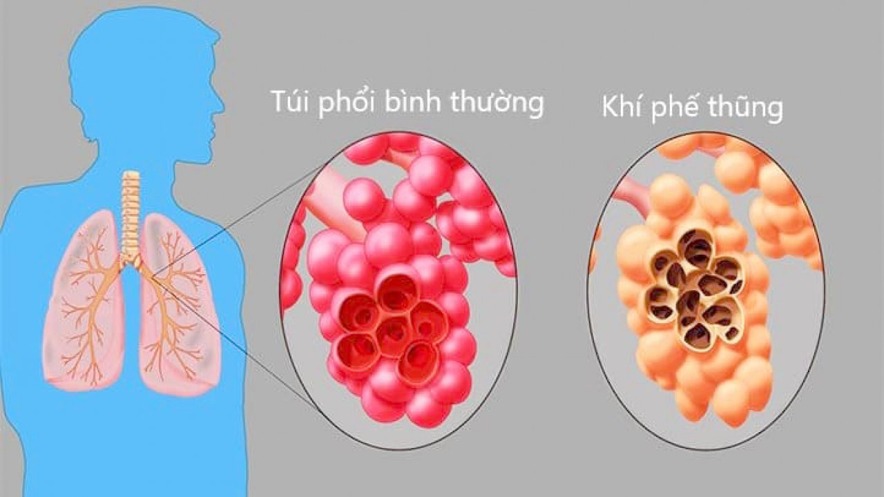 Chẩn đoán khí phế thũng phế quản tận và phế nang