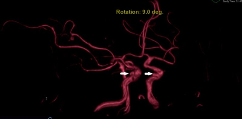 Chẩn đoán phình mạch não hiệu quả với phương pháp MRI