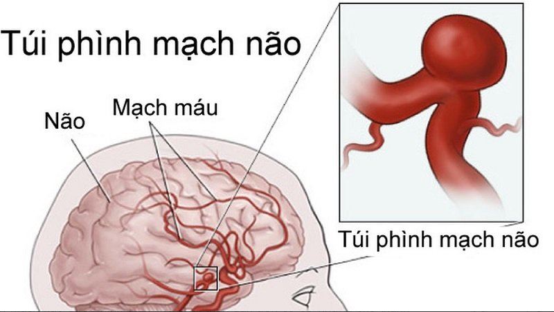 Chẩn đoán phình mạch não hiệu quả với phương pháp MRI