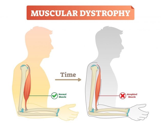 Chẩn đoán và điều trị bệnh loạn dưỡng cơ tiến triển