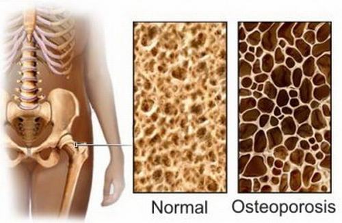Chẩn đoán và điều trị bệnh loãng xương